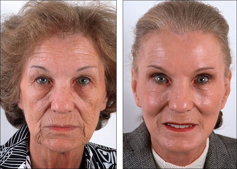Deep facial peels Deep facial peels