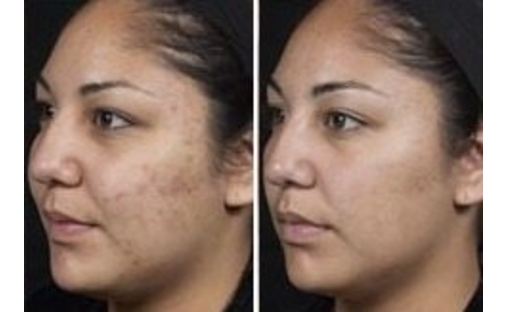 Isolaz B&A 4