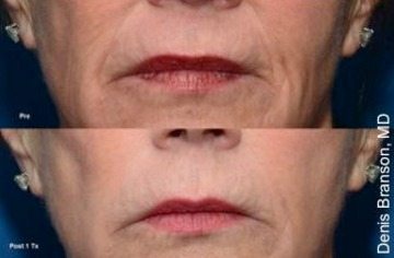 botox kybella health skin beauty beauty beauty beauty beauty beauty beauty beauty beauty beauty beauty beauty beauty beauty beauty beauty beauty salon skin skin skin botox treatment procedure hair sale eyes makeup up make up color restoration