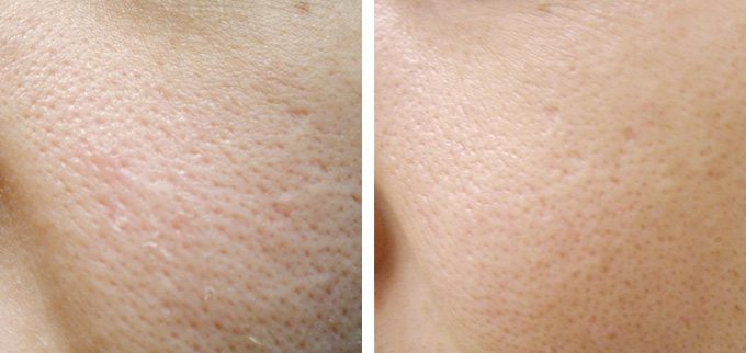 before and after photomodulation