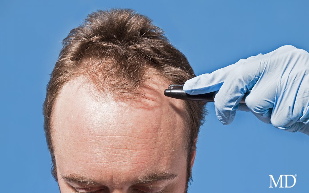 Hair Transplant? …Don’t Forget Your MD®!