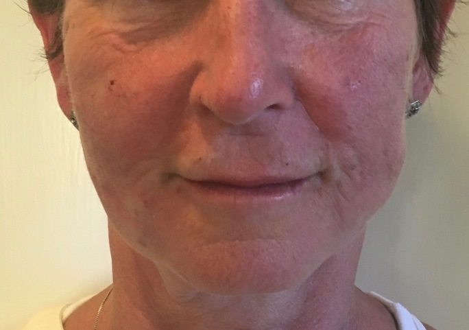 instalift thermi face lift skin tight injection procedure beauty