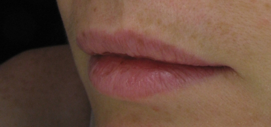 Lip Filler Before