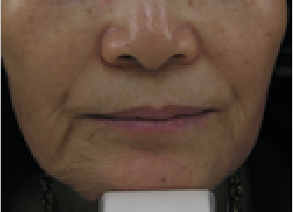 restylane before