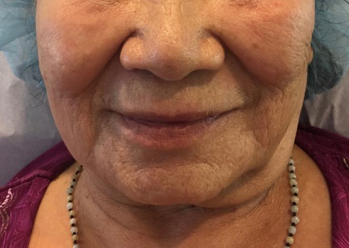 skin rejuviantion anti aging instalift