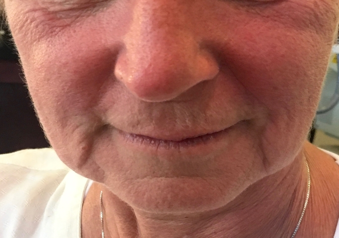 Instalift-thermi-face-lift-1-res