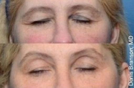 botox kybella health skin beauty beauty beauty beauty beauty beauty beauty beauty beauty beauty beauty beauty beauty beauty beauty beauty beauty salon skin skin skin botox treatment procedure hair sale eyes makeup up make up color restoration