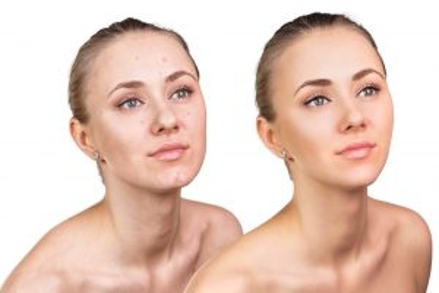 Acne scar treatment by MD Laser and Cosmetics in San Mateo
