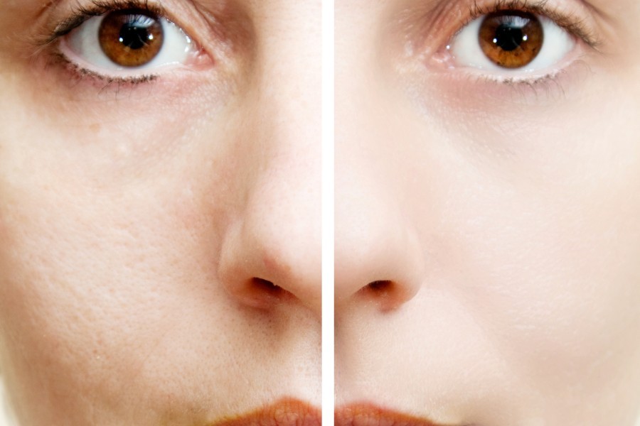 Skin Whitening Treatment Before and After