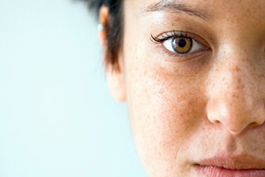 Brown spots removal by MD Laser and Cosmetics in San Mateo