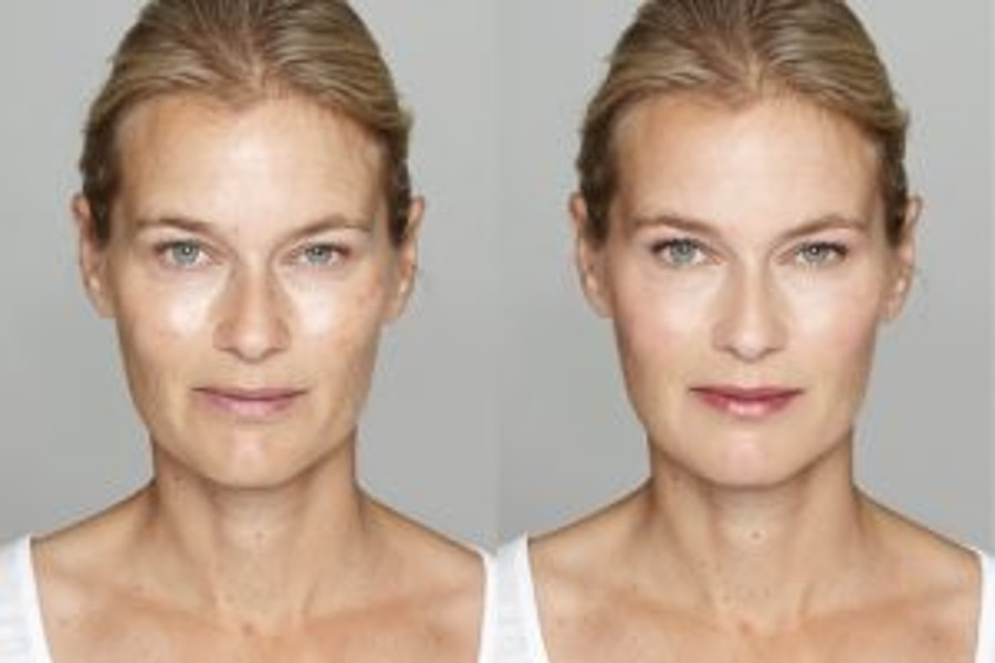 Mommy Makeover Before and After MD Laser and Cosmetics