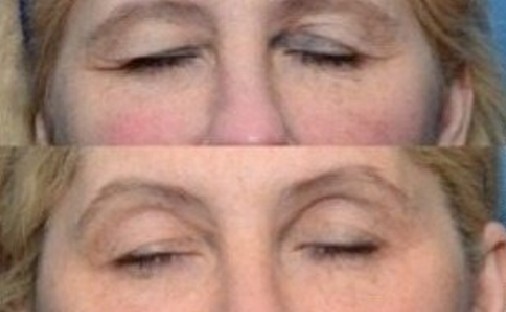 Thermiva Vaginal Rejuvenation