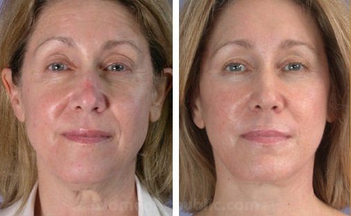 Mommy Makeover Before and After MD Laser and Cosmetics