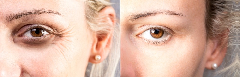 botox-injections-dysport injectable-md laser and cosmetics-san mateo-san francisco-california