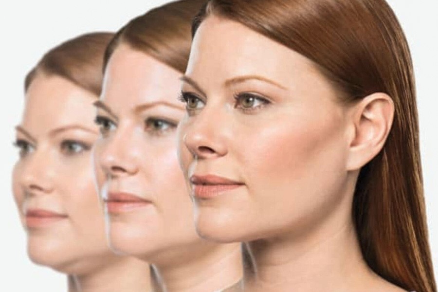 Kybella Skin Tightening