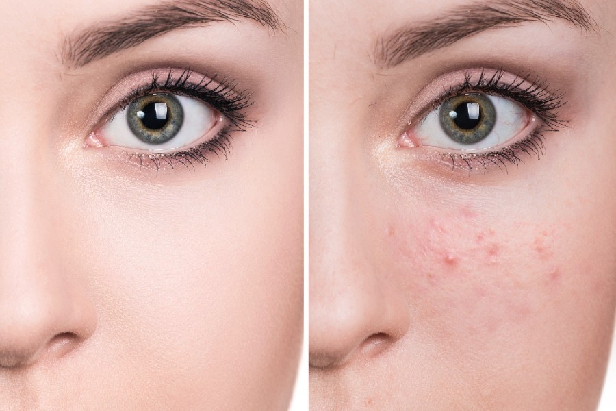 Isolaz Before and After