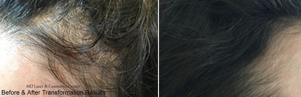 Hair Loss Treatment Before and After MD Laser and Cosmetics