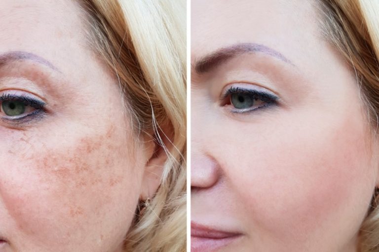 PRP Rejuvenation Before and After MD Laser and Cosmetics