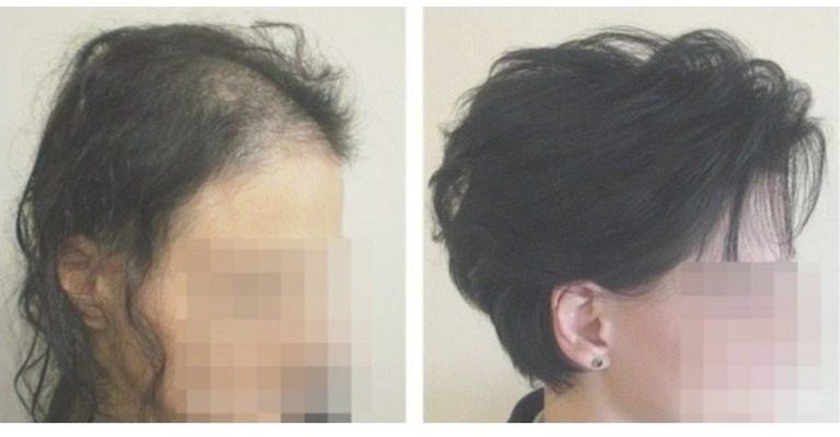PRP Treatment for Hair Loss MD Laser and Cosmetics