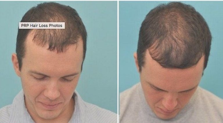 PRP Treatment for Hair Loss MD Laser and Cosmetics