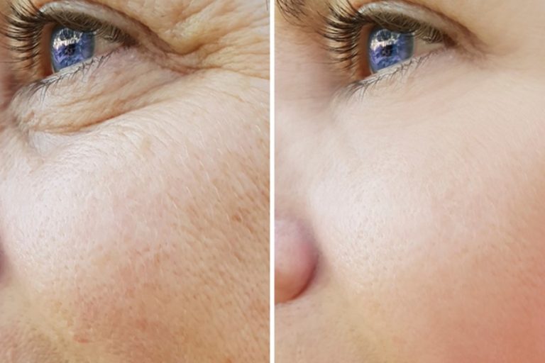 PRP Rejuvenation Before and After MD Laser and Cosmetics