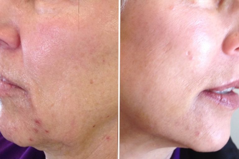 Skin Rejuvenation Before and After MD Laser and Cosmetics