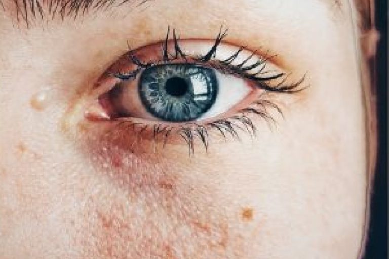 Skin pigmentation