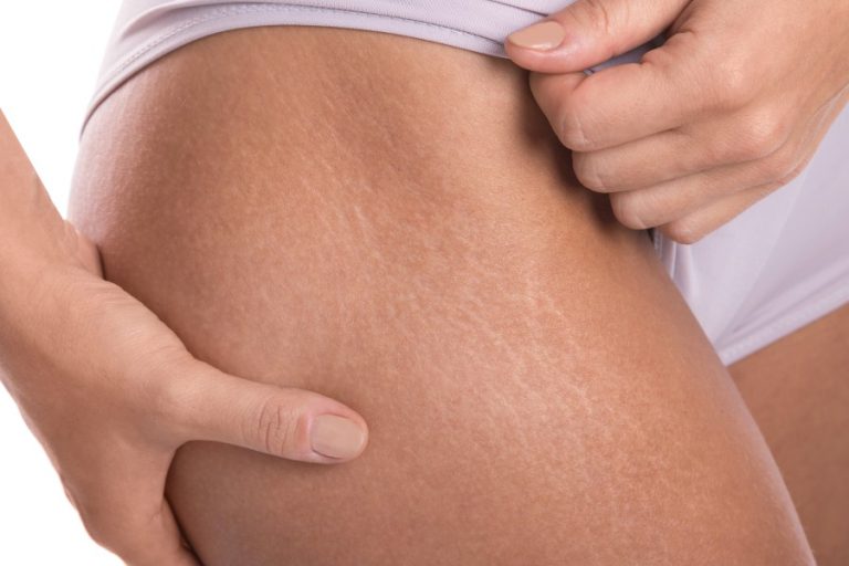 Stretch Marks MD Laser and Cosmetics