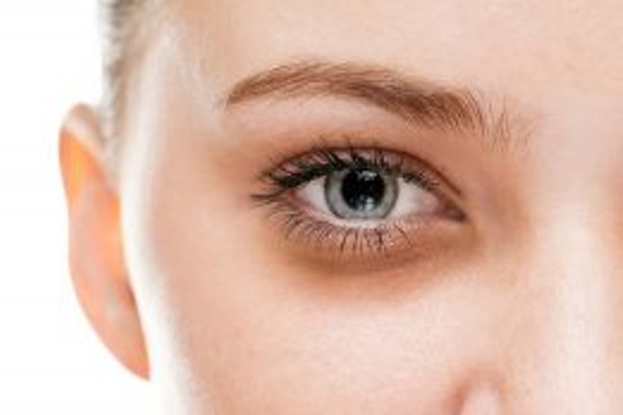 Dark circles treatment by MD Laser and Cosmetics in San Mateo