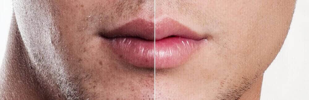 MD Cosmetics Acne treatment in San Mateo and San Francisco