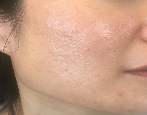 Acne scar treatment after result by MD Laser and Cosmetics in San Mateo