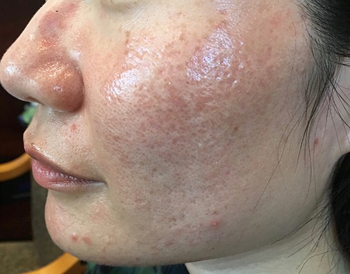 Acne scar treatment before and after y MD Laser and Cosmetics in San Mateo
