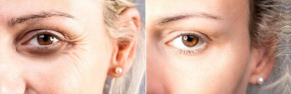 MD Cosmetics botox and dysport treatment in San Mateo and San Francisco