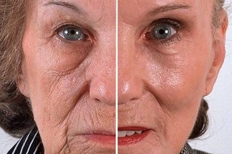 Chemical Peel Before and After