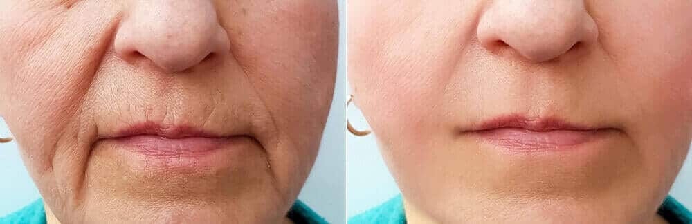 MD Cosmetics Dermal Filler treatment in San Mateo and San Francisco