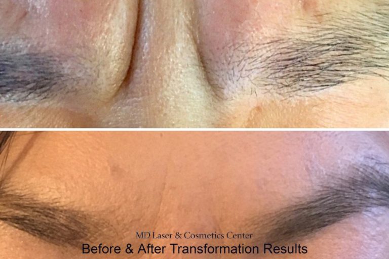 botox-injections-dysport injectable-before-and-after-md laser and cosmetics-san mateo-san francisco-california