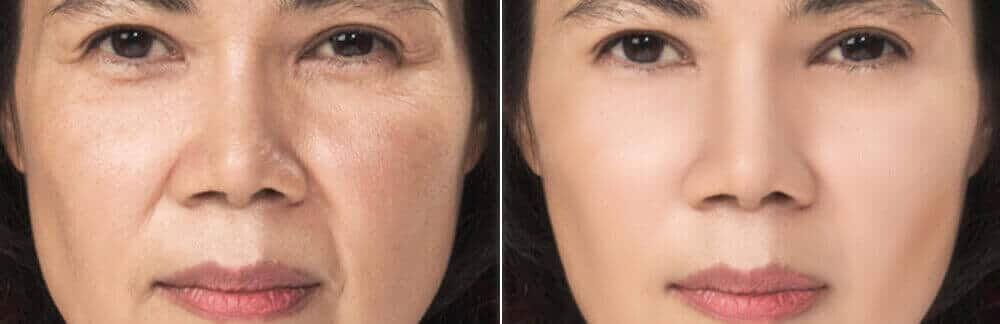 MD Cosmetics feminine rejuvenation treatment in San Mateo and San Francisco