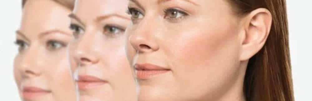 MD Cosmetics Kybella treatment in San Mateo and San Francisco