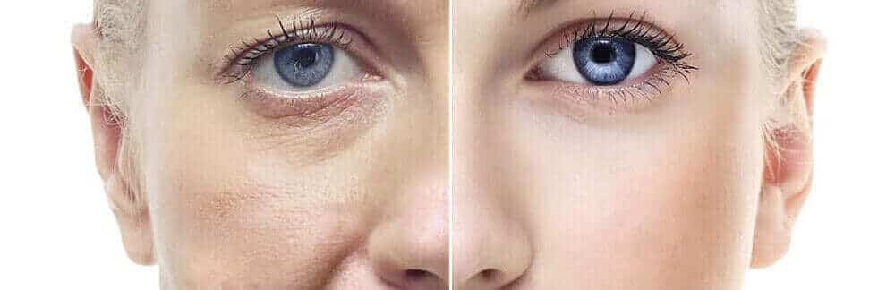 MD Cosmetics PRP rejuvenation treatment in San Mateo and San Francisco