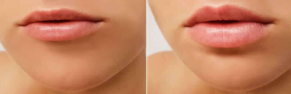 MD Cosmetics Lip Augmentation treatment in San Mateo and San Francisco