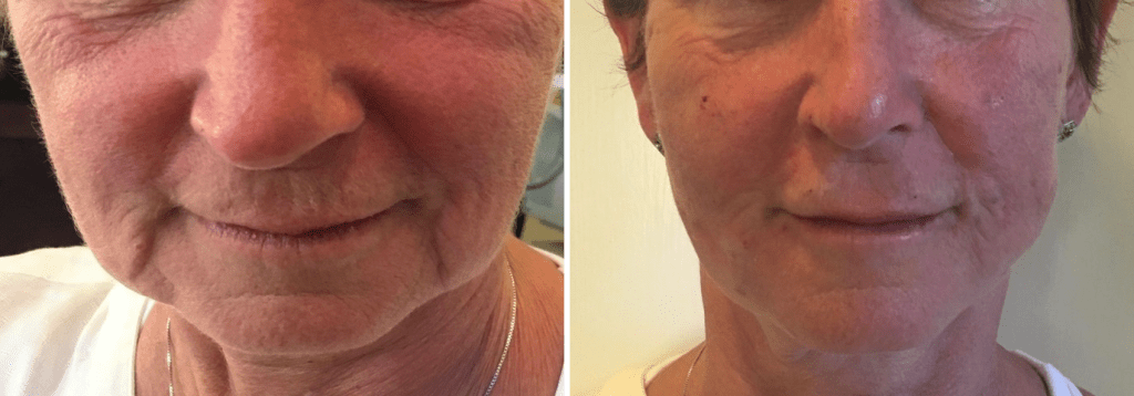 Therma Lift MD Laser and Cosmetics