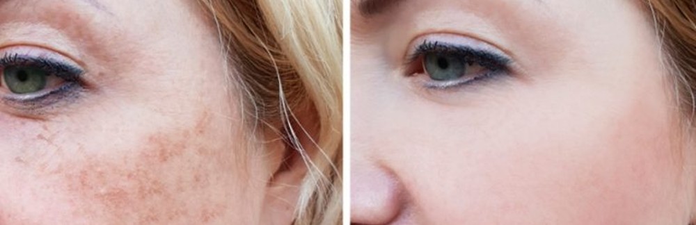 MD Cosmetics Skin Pigmentation Treatment in San Mateo and San Francisco