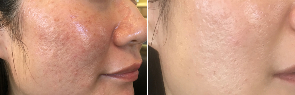 MD Cosmetics Acne Scar Treatment in San Mateo and San Francisco