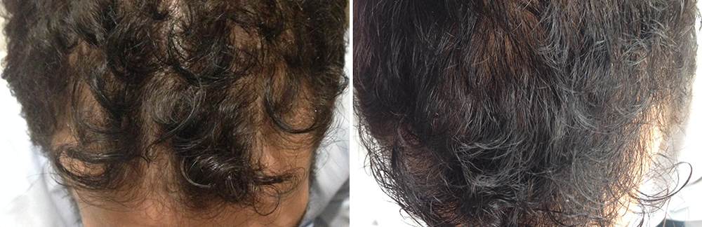 MD Cosmetics Hair Growth Treatment in San Mateo and San Francisco