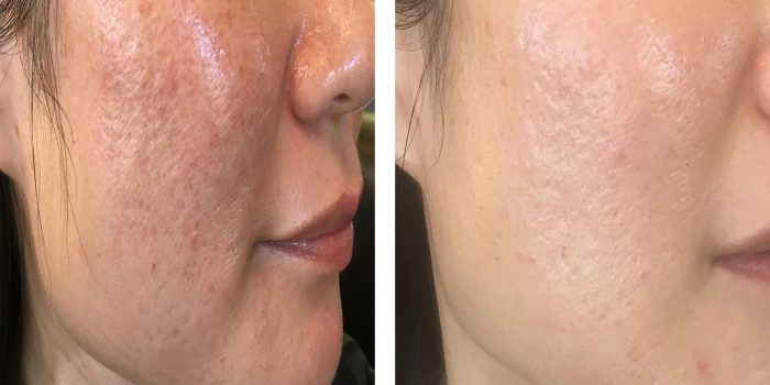 Acne scar treatment before and after 2