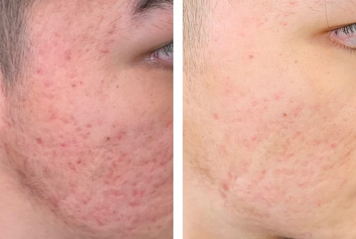 Acne scar treatment before and after 4