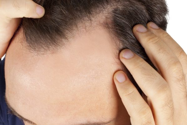 Caucasian young man controls hair loss
