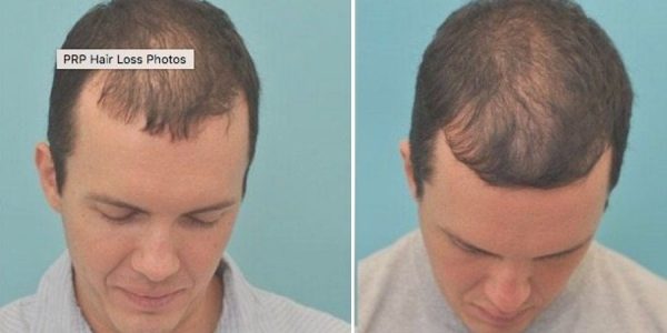 PRP Treatment for Hair Loss MD Laser and Cosmetics